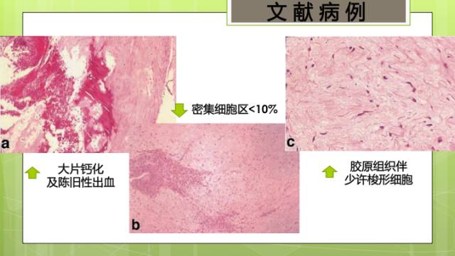 【病例】右侧海绵窦旁不典型神经鞘瘤1例CT及MR影像表现