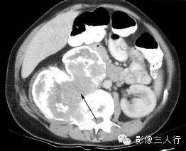 “6种” 椎体附件疾病,“一张表”告诉你如何鉴别 “6种” 椎体附件疾病,“一张表”告诉你如何鉴别
