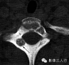 “6种” 椎体附件疾病，“一张表”告诉你如何鉴别
