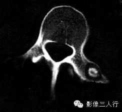 “6种” 椎体附件疾病,“一张表”告诉你如何鉴别 “6种” 椎体附件疾病,“一张表”告诉你如何鉴别