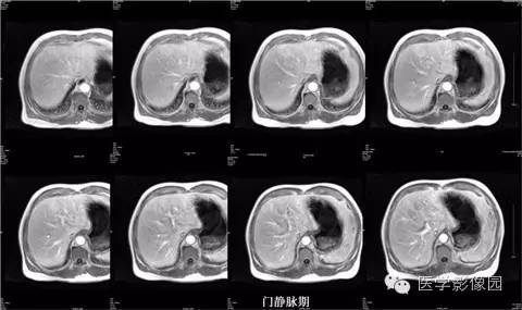 【病例】肝脏多发FNH一例MR影像表现 【病例】肝脏多发FNH一例MR影像表现