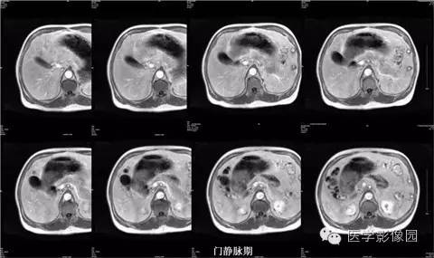 【病例】肝脏多发FNH一例MR影像表现 【病例】肝脏多发FNH一例MR影像表现