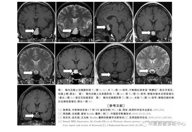 垂体Rathke囊肿的MRI表现