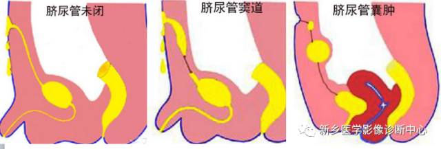 脐尿管异常 脐尿管异常