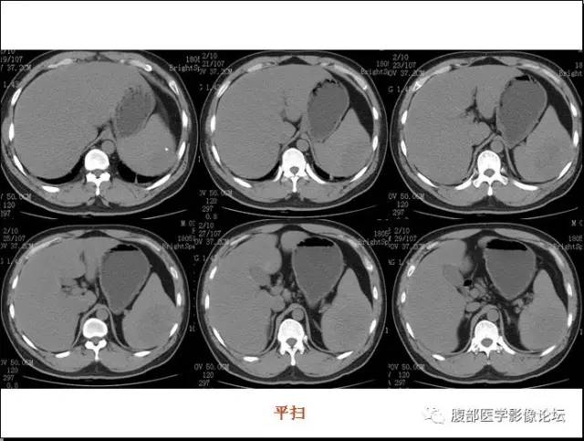 【病例】脾硬化性血管瘤样结节性转化1例CT影像表现 【病例】脾硬化性血管瘤样结节性转化1例CT影像表现