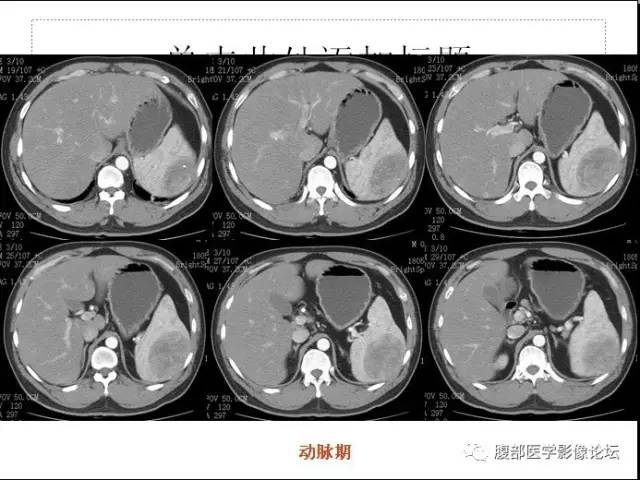 【病例】脾硬化性血管瘤样结节性转化1例CT影像表现 【病例】脾硬化性血管瘤样结节性转化1例CT影像表现