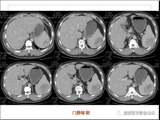 【病例】脾硬化性血管瘤样结节性转化1例CT影像表现 【病例】脾硬化性血管瘤样结节性转化1例CT影像表现