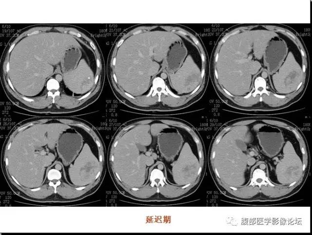 【病例】脾硬化性血管瘤样结节性转化1例CT影像表现 【病例】脾硬化性血管瘤样结节性转化1例CT影像表现