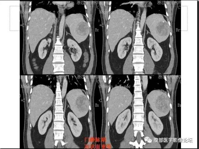【病例】脾硬化性血管瘤样结节性转化1例CT影像表现 【病例】脾硬化性血管瘤样结节性转化1例CT影像表现