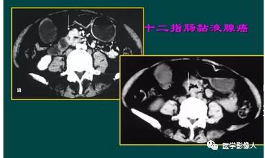 小肠肿瘤CT诊断汇总 小肠肿瘤CT诊断汇总