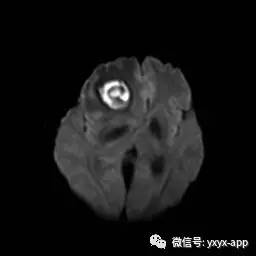 【病例】脑脓肿1例MR影像表现 【病例】脑脓肿1例MR影像表现