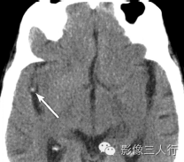 "大脑中动脉点征"，这个征象提示啥？
