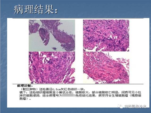 【病例】生殖细胞瘤1例CT及MR影像表现