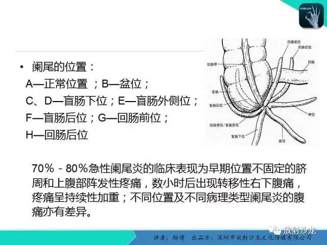 【PPT】阑尾周围脓肿