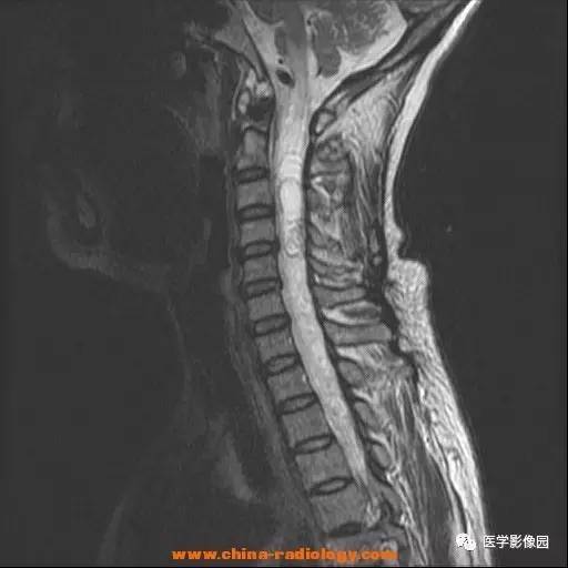 【病例】脊髓内血管母细胞瘤1例MR影像表现 【病例】脊髓内血管母细胞瘤1例MR影像表现