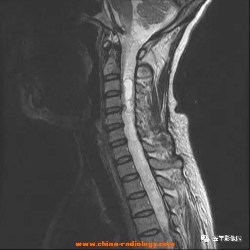 【病例】脊髓内血管母细胞瘤1例MR影像表现 【病例】脊髓内血管母细胞瘤1例MR影像表现