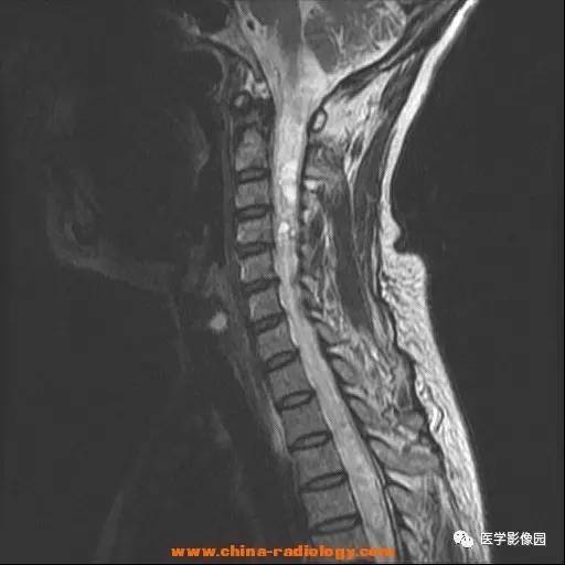 【病例】脊髓内血管母细胞瘤1例MR影像表现 【病例】脊髓内血管母细胞瘤1例MR影像表现
