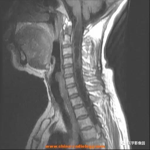 【病例】脊髓内血管母细胞瘤1例MR影像表现 【病例】脊髓内血管母细胞瘤1例MR影像表现