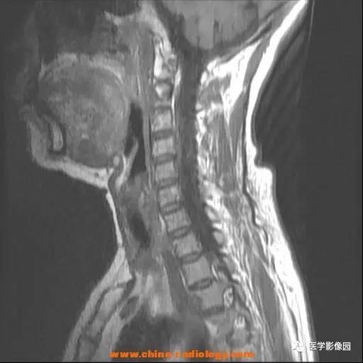 【病例】脊髓内血管母细胞瘤1例MR影像表现 【病例】脊髓内血管母细胞瘤1例MR影像表现