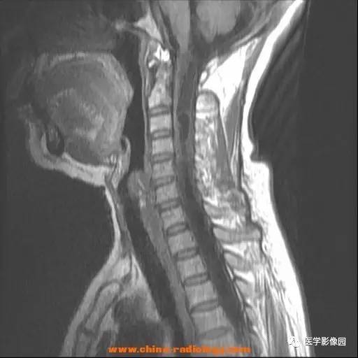 【病例】脊髓内血管母细胞瘤1例MR影像表现 【病例】脊髓内血管母细胞瘤1例MR影像表现