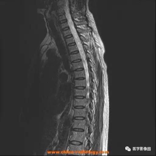 【病例】脊髓内血管母细胞瘤1例MR影像表现 【病例】脊髓内血管母细胞瘤1例MR影像表现