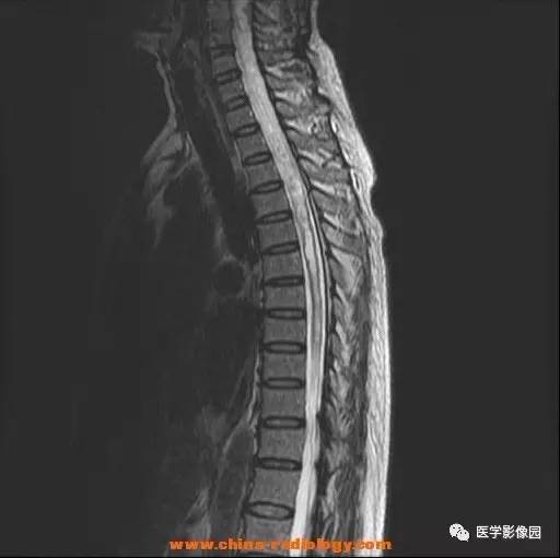 【病例】脊髓内血管母细胞瘤1例MR影像表现 【病例】脊髓内血管母细胞瘤1例MR影像表现