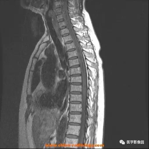 【病例】脊髓内血管母细胞瘤1例MR影像表现 【病例】脊髓内血管母细胞瘤1例MR影像表现