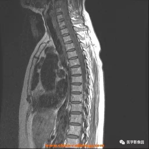 【病例】脊髓内血管母细胞瘤1例MR影像表现 【病例】脊髓内血管母细胞瘤1例MR影像表现