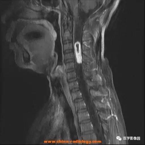 【病例】脊髓内血管母细胞瘤1例MR影像表现