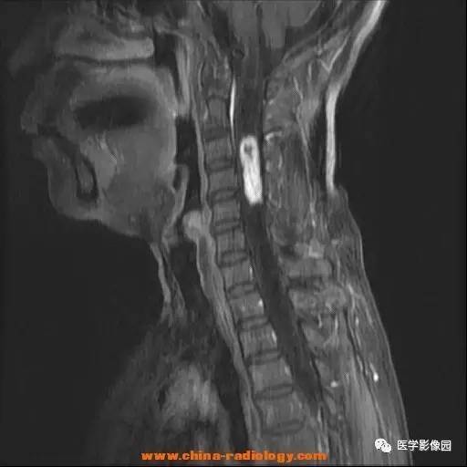 【病例】脊髓内血管母细胞瘤1例MR影像表现 【病例】脊髓内血管母细胞瘤1例MR影像表现