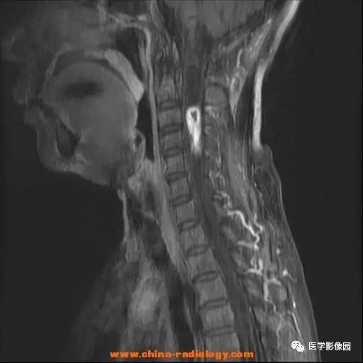 【病例】脊髓内血管母细胞瘤1例MR影像表现 【病例】脊髓内血管母细胞瘤1例MR影像表现