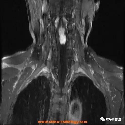 【病例】脊髓内血管母细胞瘤1例MR影像表现 【病例】脊髓内血管母细胞瘤1例MR影像表现