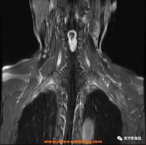 【病例】脊髓内血管母细胞瘤1例MR影像表现 【病例】脊髓内血管母细胞瘤1例MR影像表现