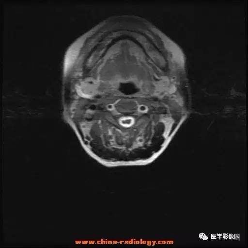 【病例】脊髓内血管母细胞瘤1例MR影像表现 【病例】脊髓内血管母细胞瘤1例MR影像表现