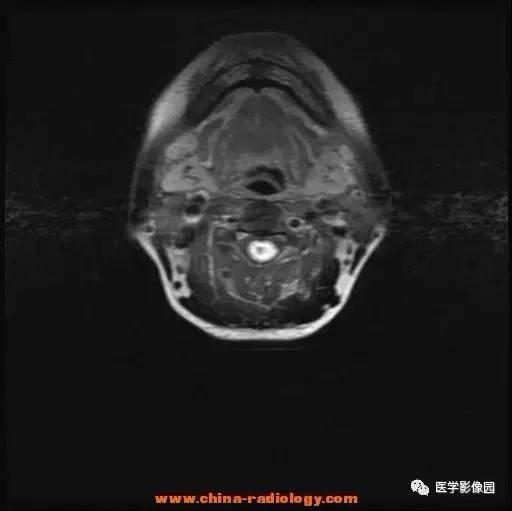 【病例】脊髓内血管母细胞瘤1例MR影像表现 【病例】脊髓内血管母细胞瘤1例MR影像表现