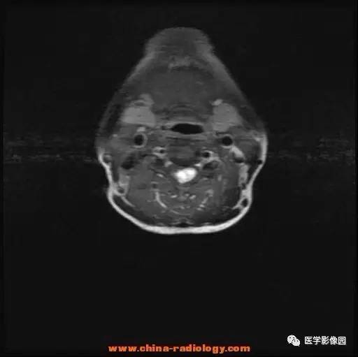【病例】脊髓内血管母细胞瘤1例MR影像表现 【病例】脊髓内血管母细胞瘤1例MR影像表现