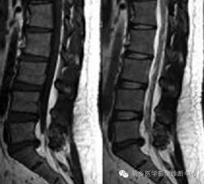 腰骶部这个地方脂肪有点多，工作中您怎么写报告？