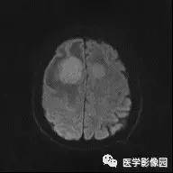 【病例】中枢神经系统淋巴瘤1例MR影像表现 【病例】中枢神经系统淋巴瘤1例MR影像表现