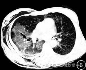 肺撕裂伤原来有四种分型，您知道吗？