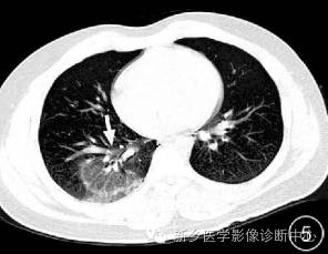 肺撕裂伤原来有四种分型,您知道吗? 肺撕裂伤原来有四种分型,您知道吗?