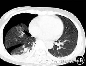 肺撕裂伤原来有四种分型,您知道吗? 肺撕裂伤原来有四种分型,您知道吗?