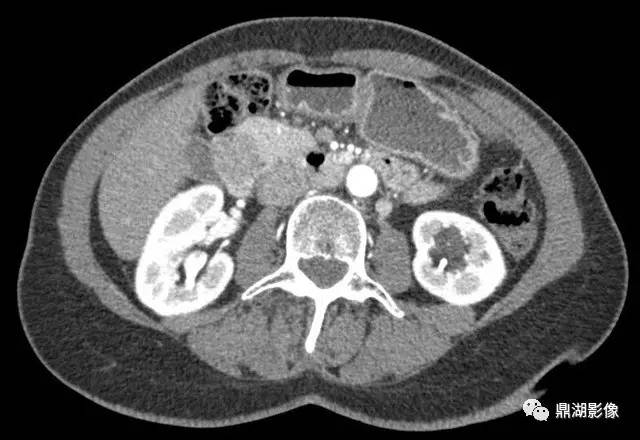 【病例】易被忽视的环状胰腺1例CT影像表现 【病例】易被忽视的环状胰腺1例CT影像表现