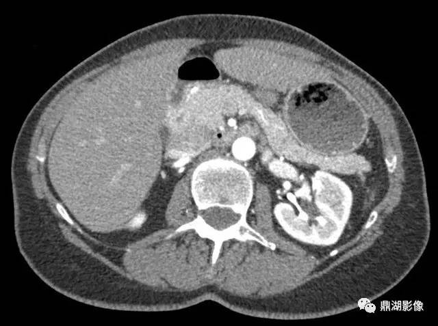 【病例】易被忽视的环状胰腺1例CT影像表现 【病例】易被忽视的环状胰腺1例CT影像表现