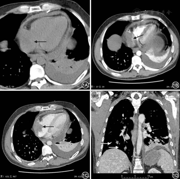 【病例】右心房血管内皮肉瘤1例CT
