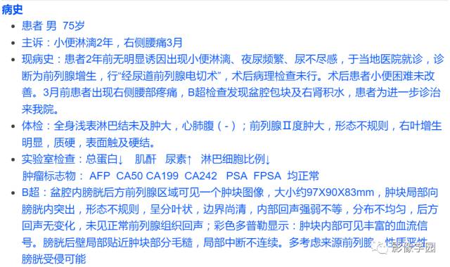【病例】前列腺恶性淋巴瘤1例CT影像表现