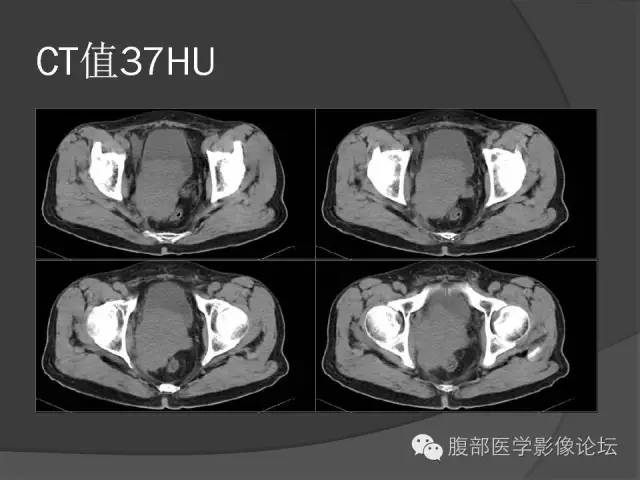 【病例】前列腺恶性淋巴瘤1例CT影像表现