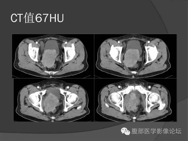【病例】前列腺恶性淋巴瘤1例CT影像表现