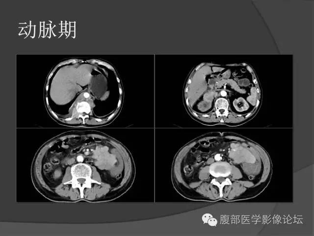 【病例】前列腺恶性淋巴瘤1例CT影像表现
