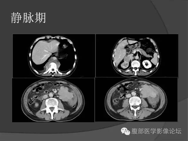 【病例】前列腺恶性淋巴瘤1例CT影像表现