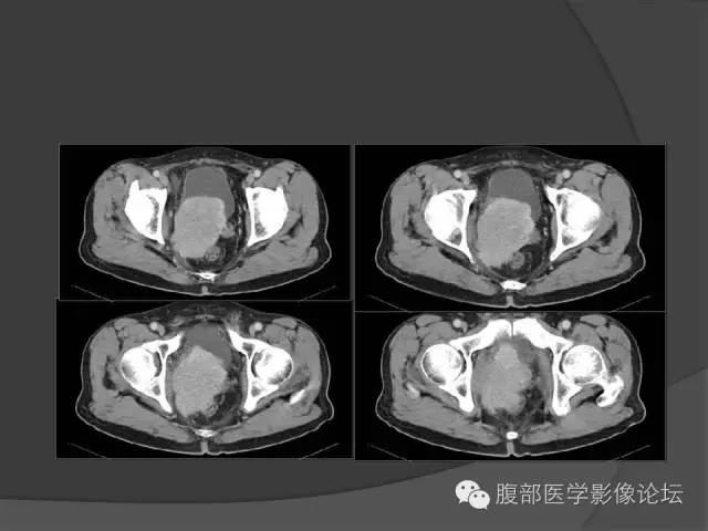 【病例】前列腺恶性淋巴瘤1例CT影像表现